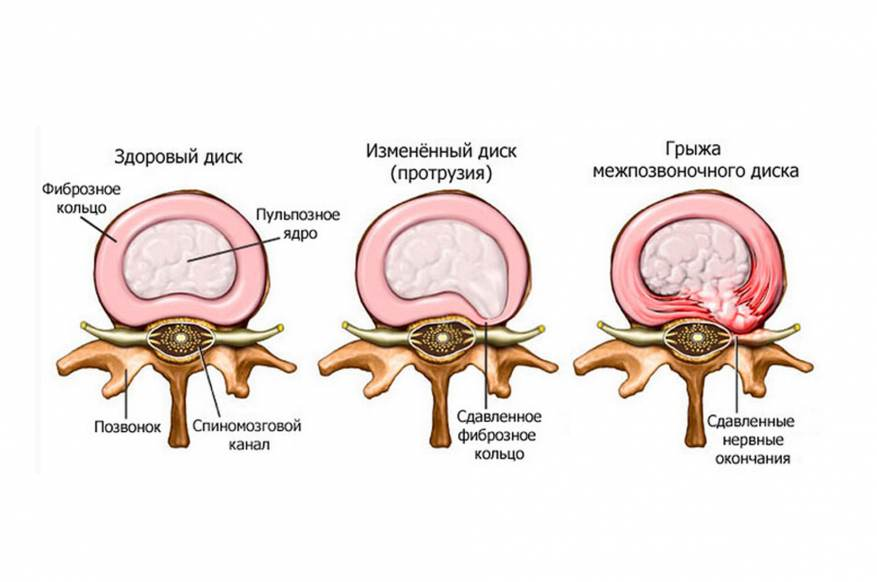 Упражнения для шеи, которые снимут боль и приведут мышцы в тонус &ndash; 1
